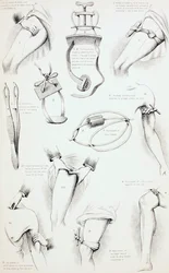Metody zatrzymania krwawienia, ok. 1890 r.