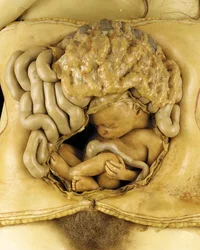 Model anatomiczny ciąży jajnikowej, detal (wosk) (patrz również 1126545-7)