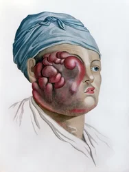 Skrofula rakowa, z Description des Maladies de la Peau autorstwa barona Jean Louis Alibert (1768-1837) Paryż, 1806