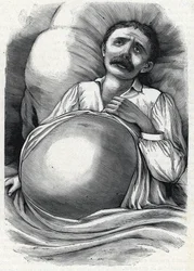 Pacjent z zaawansowaną marskością wątroby (grawer) 1888