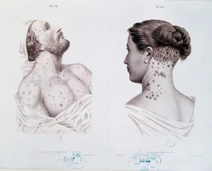 Objawy kiły u mężczyzn i kobiet, z książki medycznej, ok. 1850-60