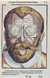 Leczenie choroby oka, z Ophthalmodouleia Georga Bartischa (1535-1636) wydanej w Dreźnie w 1583 r. (kolorowy drzeworyt)