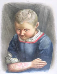 Favus, z książki Daniela Corneliusa Danielssena (1815-94) 1892