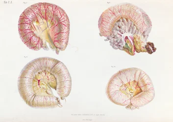Zewnętrzna powierzchnia jelit zakażonych cholerą, z Anatomie Pathologique du Cholera Morbus, Nikołaja Iwanowicza Pirogowa (1810-81) opublikowanej w Petersburgu, 1849