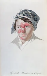 Krosty kiły, z książki barona Jeana Louisa Aliberta (1768-1837) 1838