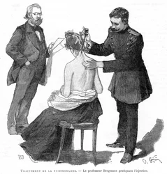 Profesor Bergmann wstrzykuje pacjentowi gruźlicę, 1891