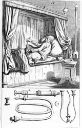 Clystère (do lewatyw) Johannesa Sculptetusa „”Armamentarium Surgical””. Wenecja 1665