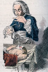 Trepanacja. Odbitka z XVIII wieku.