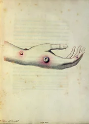 Krosta krowianki na ramieniu Sarah Nelmes, z „Aninquiry into the Causes and Effects of the Variolae Vaccinae” Edwarda Jennera (1749-1823), grawerowana przez Pearce